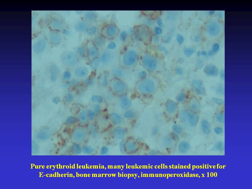 Fig. 6. Pure erythroid leukemia, many leukemic cells stained positive for E-cadherin, bone marrow biopsy, immunoperoxidase, x 100